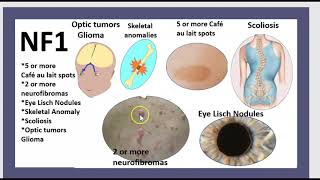 Neurofibromatose de type 1 NF1 Type 2 NF2 Neurinome de lacoustique Schwannome vestibulaire 3 mn [upl. by Knowle]