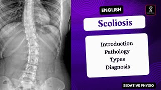 Scoliosis  Types Pathology Clinical Features  Orthopedic deformity  Sedative Physio [upl. by Debarath147]