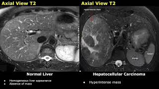 Liver MRI Normal Vs Hepatocellular Carcinoma HCC Images  T1 T2 DWI ADC amp Contrast Sequences [upl. by Ahsart]