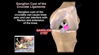 Ganglion Cysts Around The Knee  Everything You Need To Know  Dr Nabil Ebraheim [upl. by Dnomse]