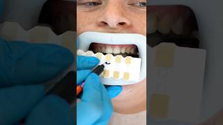 DENTIST APPROVED Teeth Whitening ASMR Experience [upl. by Aciruam]