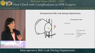 Intraoperative Bile Leak During Hepatectomy [upl. by Ayvid]