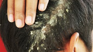 Dandruff scratching comb on head using black combing0 [upl. by Arrais391]