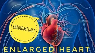 Enlarged Heart or Cardiomegaly  Causes Prevention amp Treatment  About Health [upl. by Akilak]