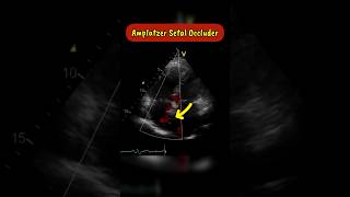 Amplatzer Septal occluder as seen on Echocardiogram echocardiography heart asd [upl. by Rudin]