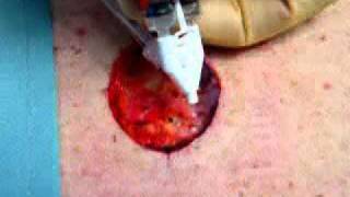 Fibrin Spray to Aid in Wound Healing [upl. by Meekar292]