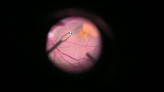 Vitrectomy with internal limiting membrane ILM peeling [upl. by Anaigroeg109]