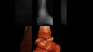 multiple intraarticular epiphyseal osteochondromas in the tibiotalar joint [upl. by Aleacim]