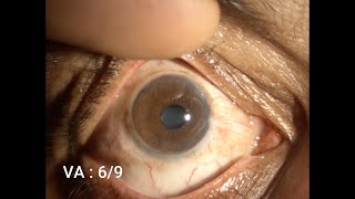 Therapeutic Keratoplasty Step by Step [upl. by Llyrad]