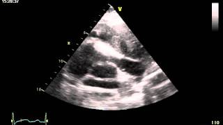 MEDIASTINAL MASS RVOT  ECHOCARDIOGRAPHY cardiac ultrasound [upl. by Meggi]