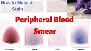 Peripheral Blood Smear Peripheral Smear Examination  Leishmans Staining Procedure [upl. by Kathe]