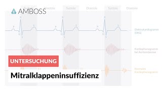 Mitralklappeninsuffizienz  Herzgeräusch  AMBOSS Video [upl. by Teerprug]