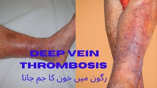 Deep Vein Thrombosisرگون میں خون کا جم جانا [upl. by Avie731]