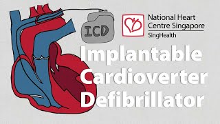 What is an Implantable CardioverterDefibrillator ICD  What to Expect [upl. by Acire]