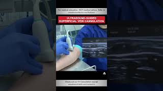 Ultrasoundguided Superficial Vein Cannulation  shorts ivcannulation anesthesiology nurse [upl. by Froma]