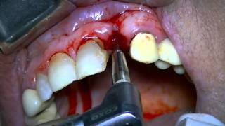 Implant placement using bone expansion technique [upl. by Blunt531]