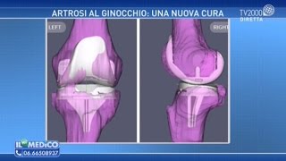 Artrosi al ginocchio una nuova cura [upl. by Orlina]