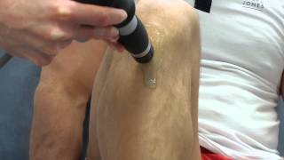 Osgood Schlatter shockwave [upl. by Annauj914]