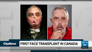 First face transplant performed in Canada [upl. by Sonitnatsnoc816]