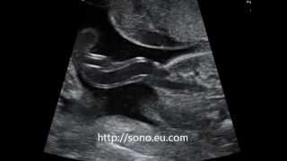 Single Umbilical Artery on Fetal Ultrasound [upl. by Oratnek407]