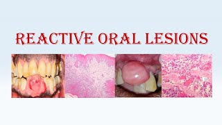 Oral Pathology 2  Reactive Oral Lesions [upl. by Ganley]