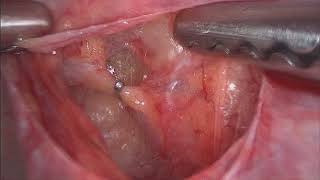 Uterine Artery Ligation Clipping  Anterior and Posterior Approach [upl. by Suiram303]