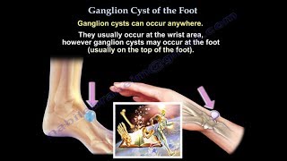 Ganglion Cyst Of The Foot  Everything You Need To Know  Dr Nabil Ebraheim [upl. by Aillicec14]