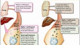 alpha 1 antitrypsin deficiency [upl. by Yokoyama]