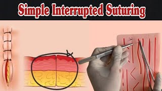 Simple Interrupted Suturing  Simple Suture Procedure [upl. by Der901]