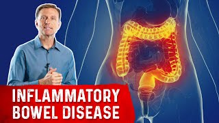 The Most Common Nutrient Deficiency in IBD Inflammatory Bowel Disease [upl. by Verras]