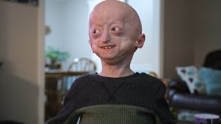 Hear from Zach Pickard 11 year old with progeria [upl. by Brodie476]