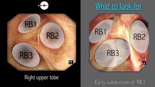 Mastering Bronchoscopy for Thoracic Surgery Chapter 2 [upl. by Eimrots895]