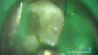 Acute Apical Periodontitis Nonsurgical Root Canal Treatment [upl. by Dnomar456]