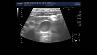 Mesenteric lymphadenitis [upl. by Hsan803]