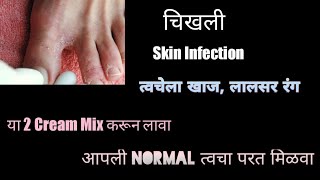 Best Cream For Fungal InfectionLuliconazole amp Mometasone Cream Information In Marathi [upl. by Skilken]