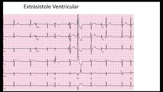 Extrasistole Auricular y Ventricular EKG [upl. by Yadroc]