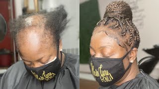 BOX BRAIDS ON SEVERE ALOPECIA CLIENT  TOP BUNKNOT [upl. by Neufer298]