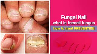 Nail Nail Health Tips Best Home Remedy Cure for Toenail Fungus  Health tips [upl. by Nnylecyoj]