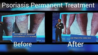 Psoriasis Permanent Treatment  Testimony Of Hemohim For Psoriasis Atomy Hemohim Amazing Product [upl. by Merv488]