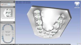 Dental Model Analyses in Planmeca Romexis® 3D Ortho Studio [upl. by Lay43]