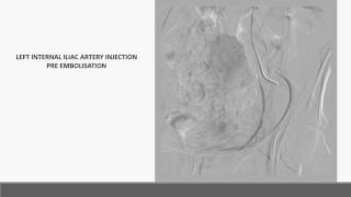 Preoperative sacral tumor embolisation [upl. by Lurleen265]