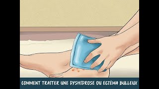 Comment traiter une dyshidrose ou eczéma bulleux [upl. by Queston]