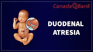 Duodenal Atresia [upl. by Seamus]