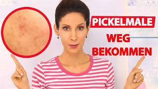 Aknemale entfernen  Pickelmale loswerden  Die 5 besten Tipps 👍 [upl. by Ellimak]