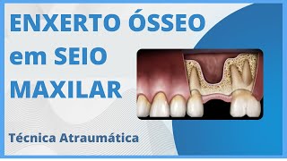 ENXERTO ÓSSEO MAXILAR  TÉCNICA ATRAUMÁTICA [upl. by Southworth427]