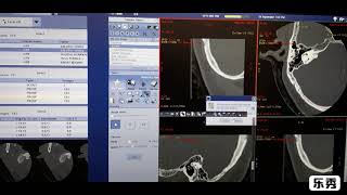 HRCT TEMPORAL BONE FILMING ON GE CT SCAN MACHINE [upl. by Renrew]