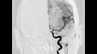 Cerebral aneurysm angiogram [upl. by Natka822]