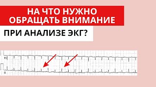 Что НЕ стоит игнорировать при анализе ЭКГ На что стоит обращать внимание при анализе ЭКГ [upl. by Eyar207]