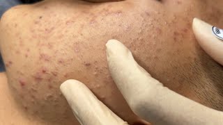 Blackheads amp Whiteheads Removal New 2024  Acne Treatment With Bo Nguyễn Spa 007 [upl. by Pontius681]