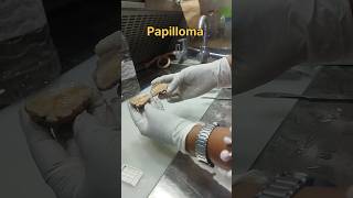 Papilloma thigh tissue papilloma polyp tissue tissuepreparation tissueprocessing [upl. by Lenaj]